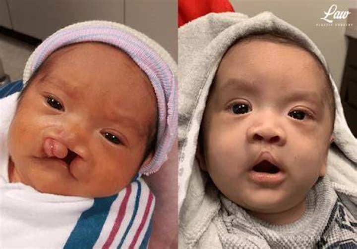 cleft lip before and after surgery